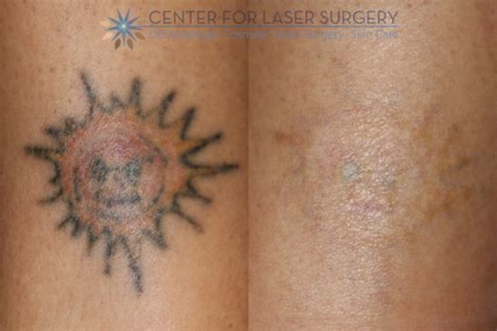 Unveiling The Truths: Tattoos Before Surgery