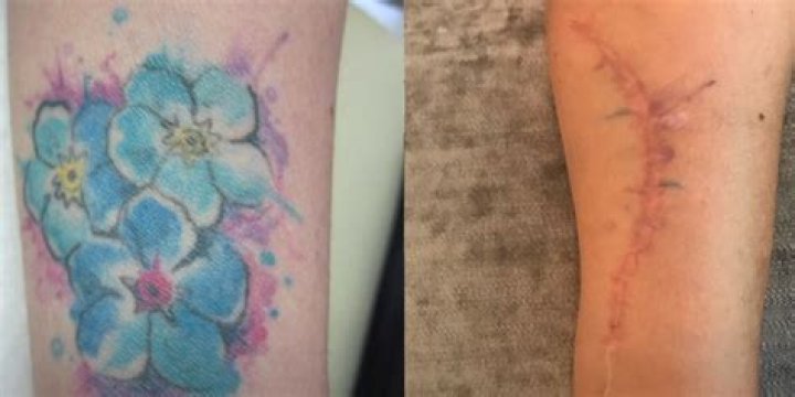 Get Inked Before Surgery: Unraveling The Enigma