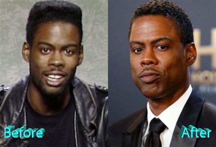 Unveiling Chris Rock's Surgical Journey: Surprises And Revelations