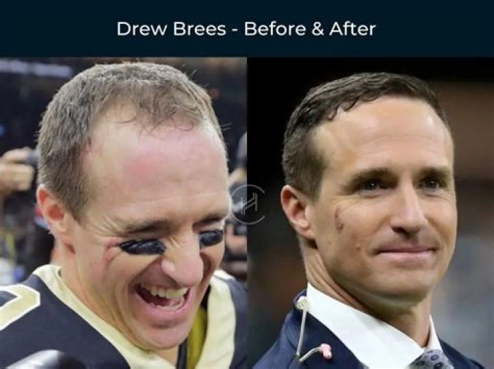 Uncovering The Insights Behind Drew Brees' Son's Rare Condition