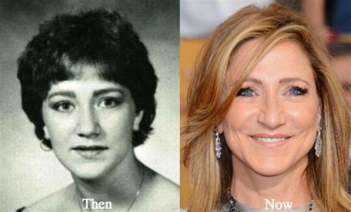 Edie Falco's Plastic Surgery Journey Revealed