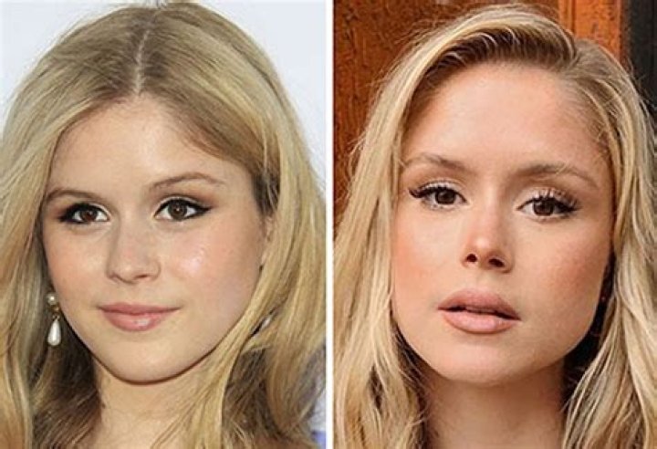 Unveiling Erin Moriarty's Transformation: Buccal Fat Removal Insights