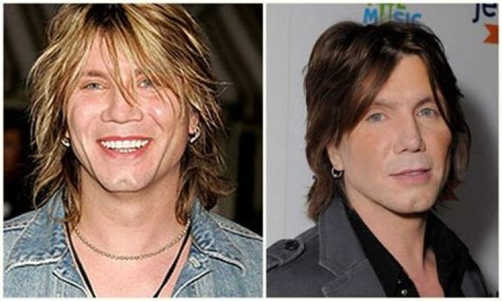 The Truth About Goo Goo Dolls Lead Singer's Plastic Surgery Revealed