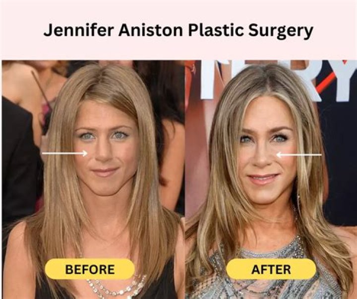 Has Jennifer Aniston Had Plastic Surgery