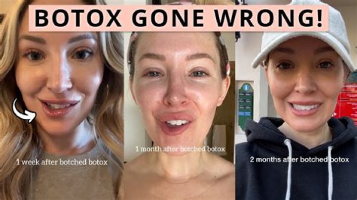 Ultimate Guide To Fixing Bad Botox