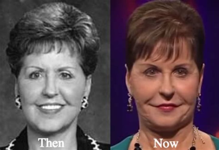Joyce Meyer's Journey Before Facelift