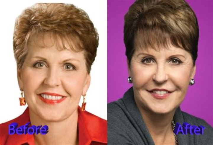 Discover Joyce Meyer's Non-Surgical Transformation