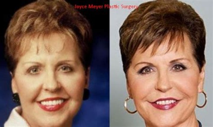 Unveiling The Truth Behind Joyce Meyer's Plastic Surgery Transformation