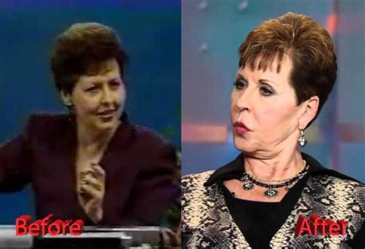 Joyce Meyers Plastic Surgery And Its Impact
