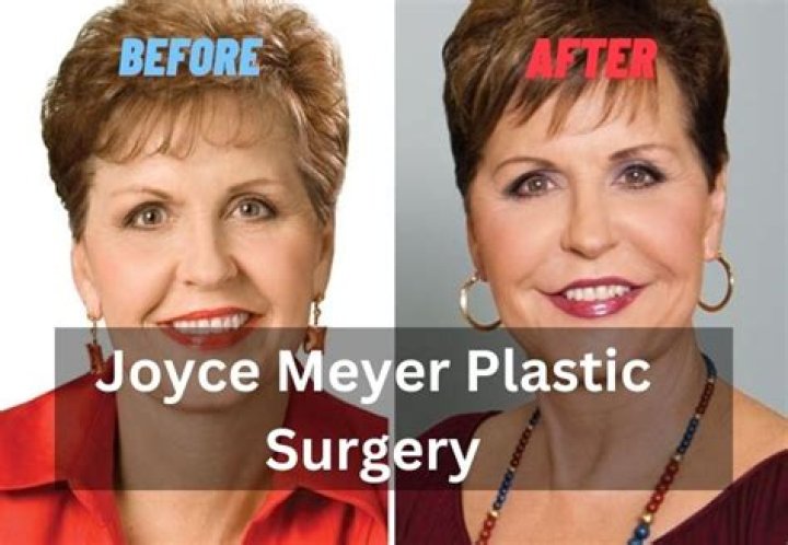 Uncover Joyce Meyers' Plastic Surgery Journey: Discoveries And Insights
